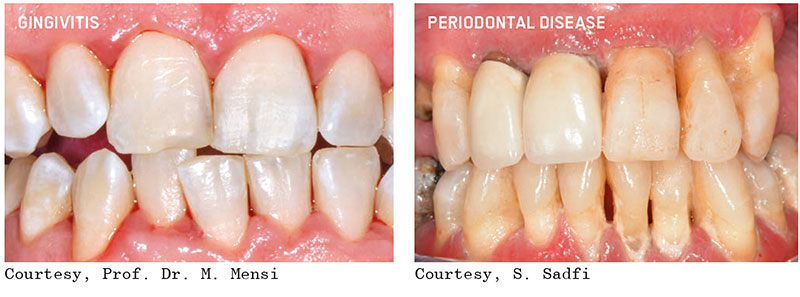 Guided Biofilm Therapy Before After Photos in Columbus 