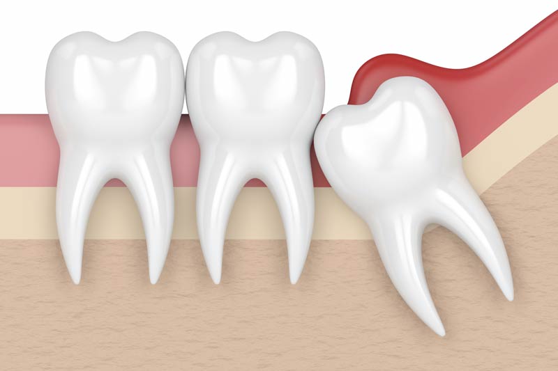 Tooth Extractions in Columbus